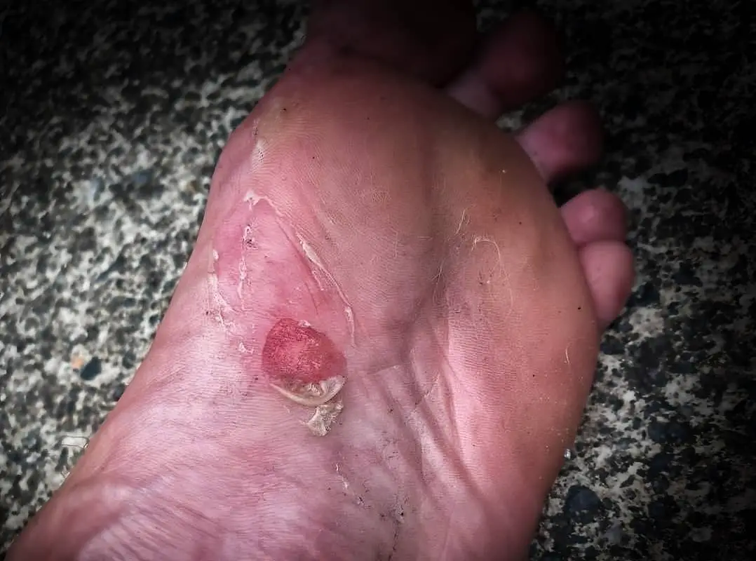 foot blister